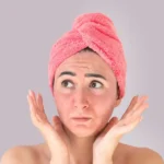 Woman with Bad Skin and a Sunburn