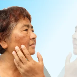 Woman with Adult Acne