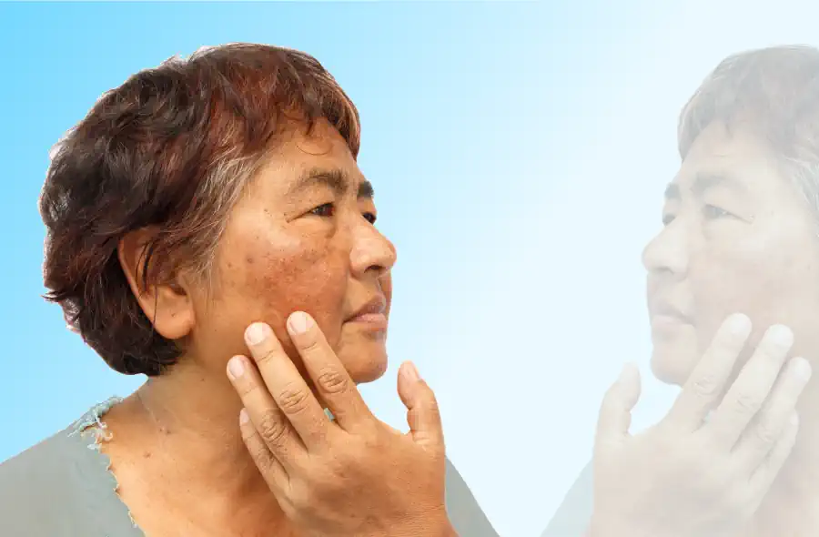 Woman with Adult Acne