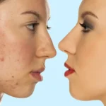 Is Acne Contagious?