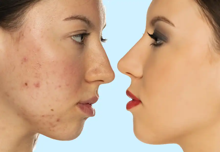 Is Acne Contagious?