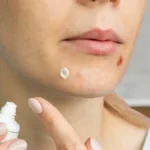 Using Toothpaste on Acne