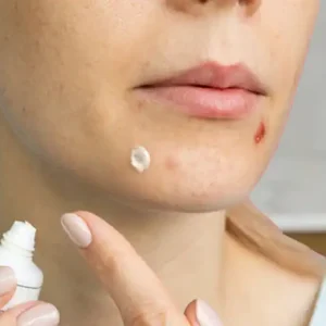 Using Toothpaste on Acne