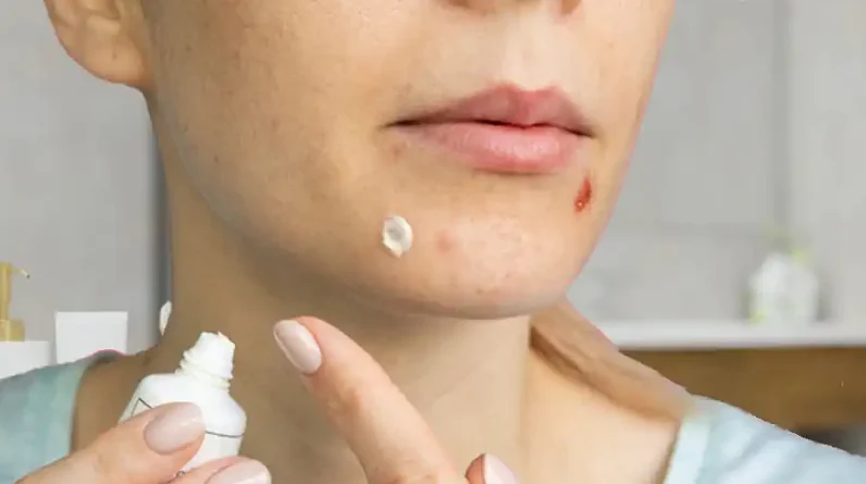 Using Toothpaste on Acne