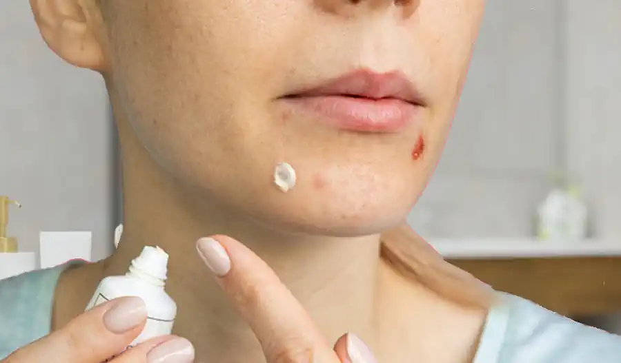 Using Toothpaste on Acne