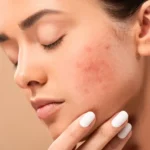 Dry to Normal Skin and Acne