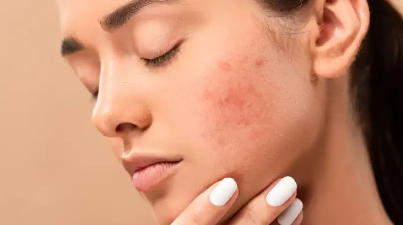 Dry to Normal Skin and Acne