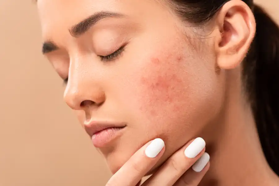 Dry to Normal Skin and Acne