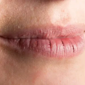 Woman with Chapped Lips