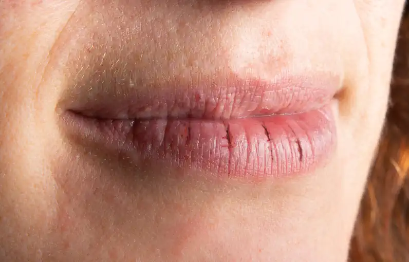 Woman with Chapped Lips