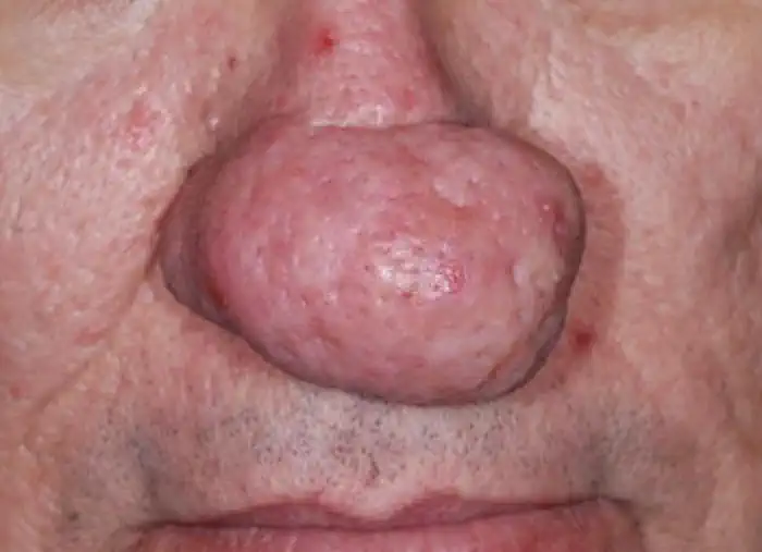 Phymatous Rosacea