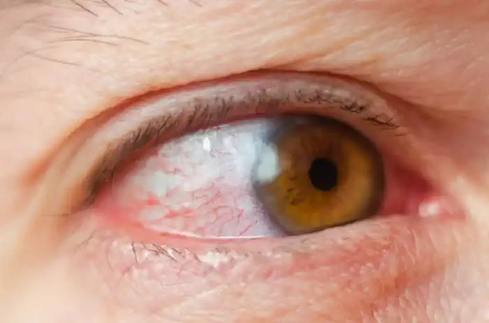 Ocular Rosacea