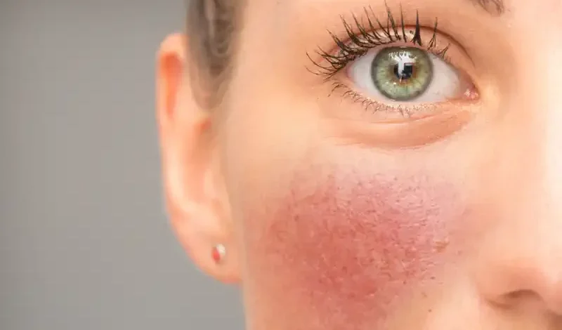 Woman with Rosacea