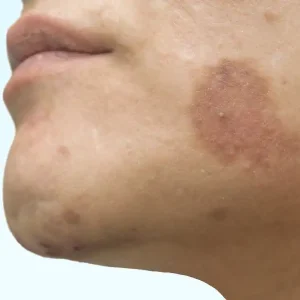 Age Spot on Face