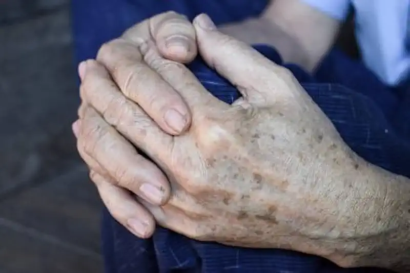 Age Spots on the Hands