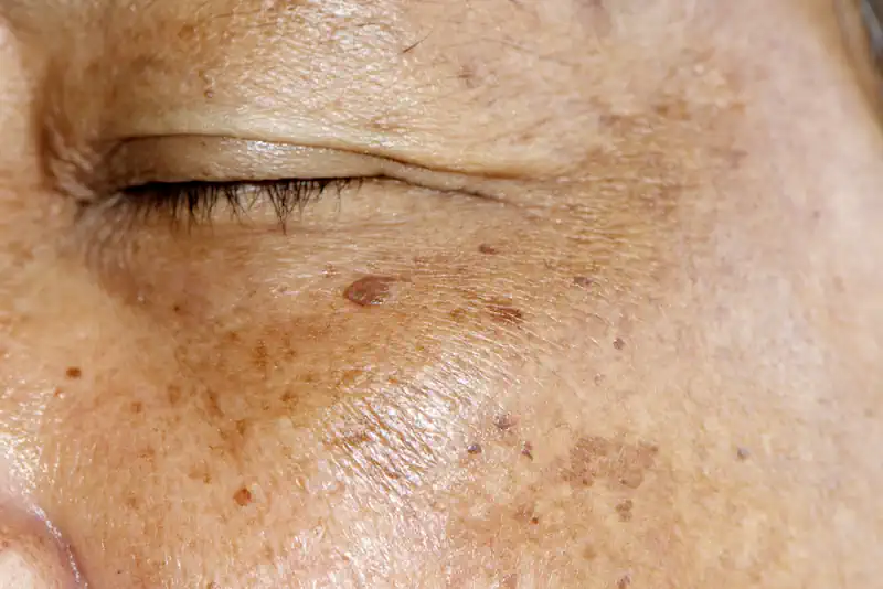 Small Brown Age Spots